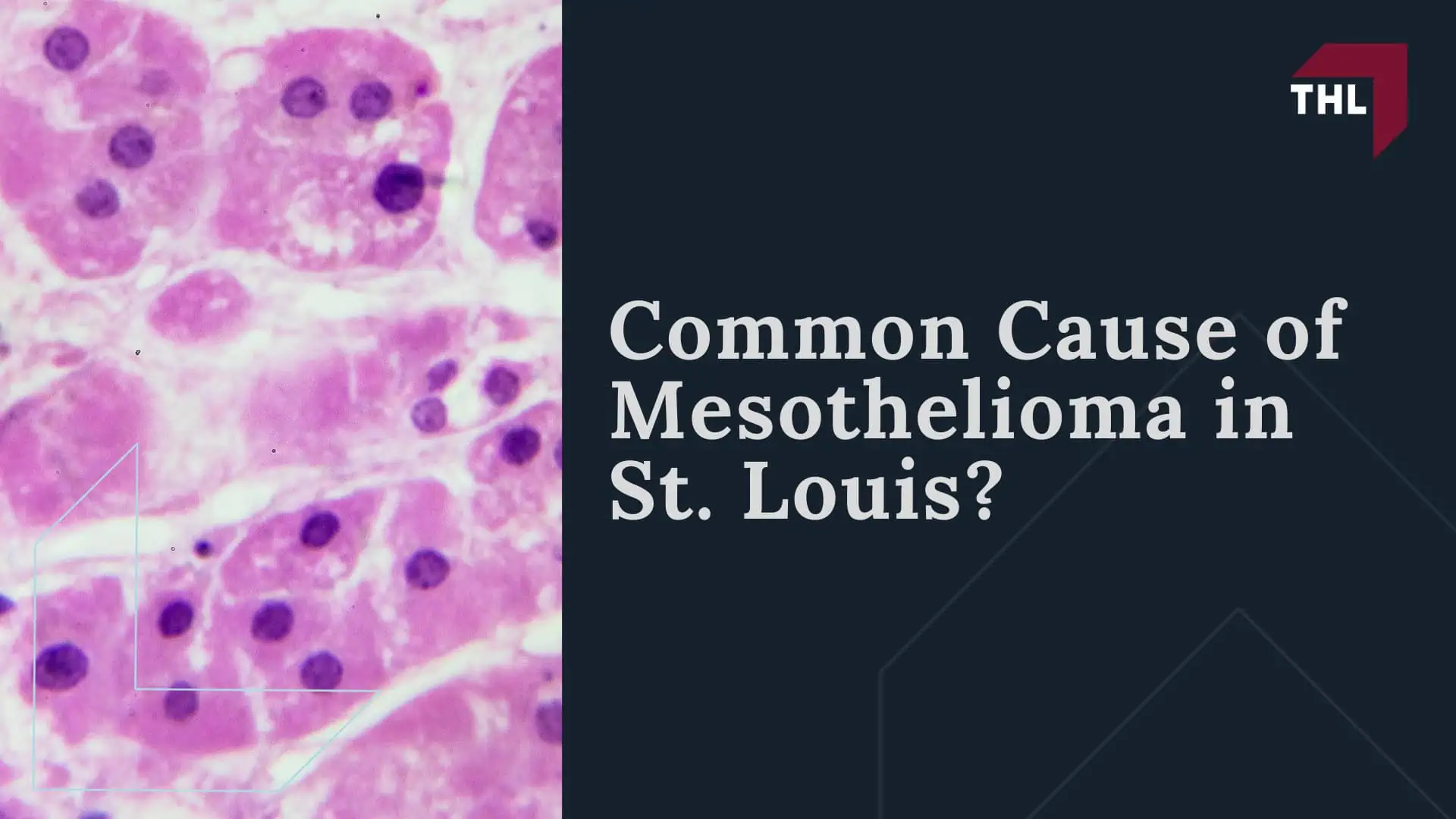 Common Cause of Mesothelioma in St. Louis