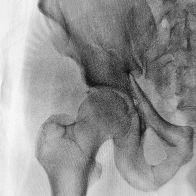 Defective Hip Replacement-Lawsuit-Settlement