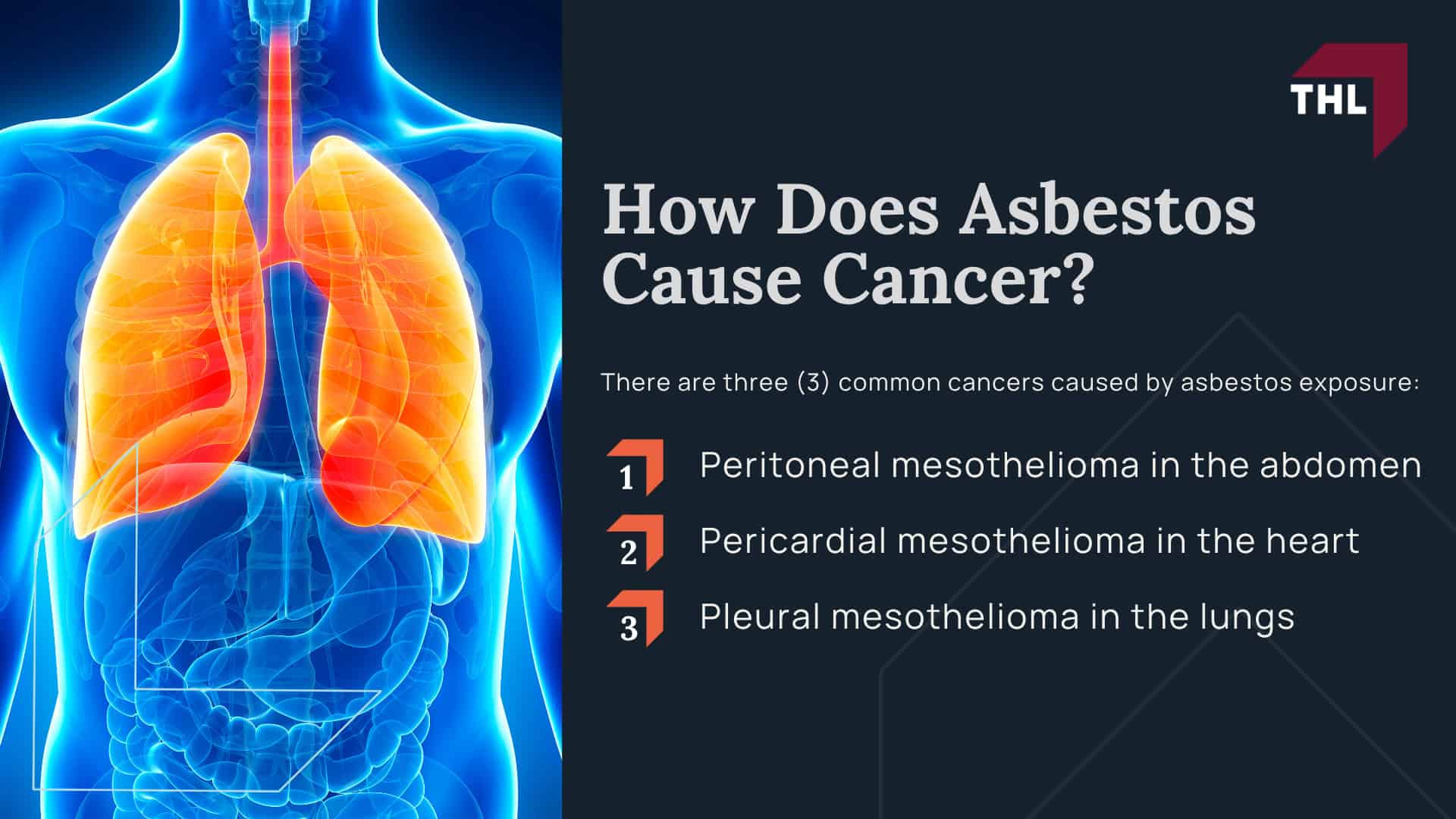 What Causes Mesothelioma; Mesothelioma & Exposure to Asbestos; What is Asbestos; Where Can You Be Exposed to Asbestos in Chicago; How Does Asbestos Cause Cancer
