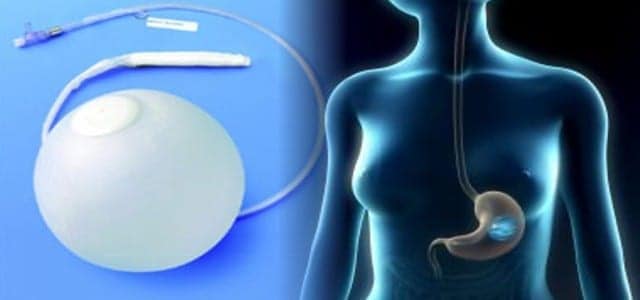 intragastric balloon system