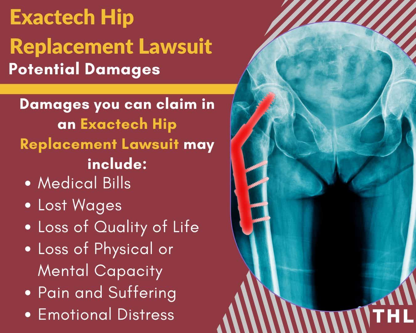 Exactech lawsuits claims and damages