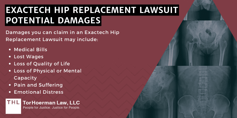 Exactech Hip replacement Lawsuit potential damages