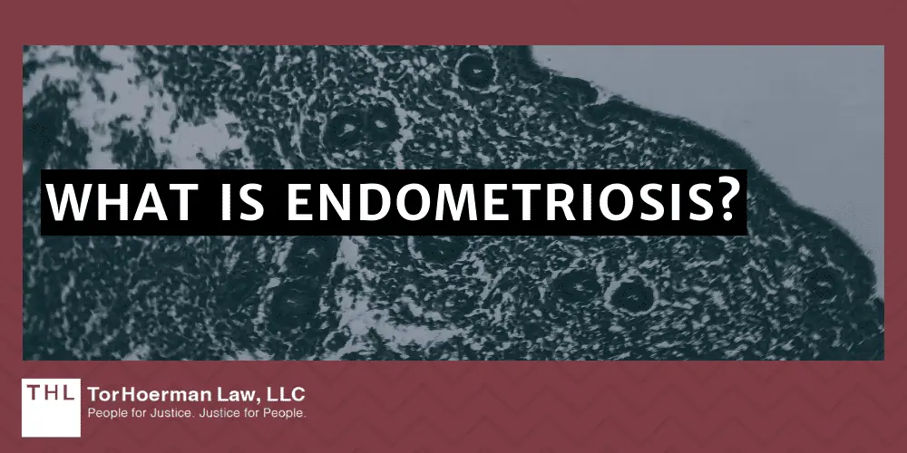 What is Endometriosis?