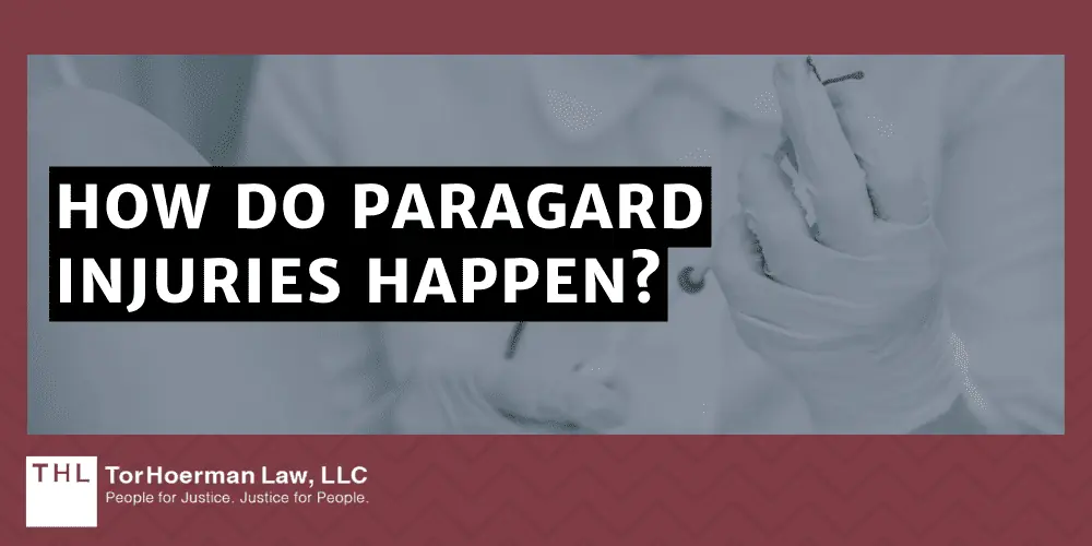 How Do Paragard Injuries Happen?