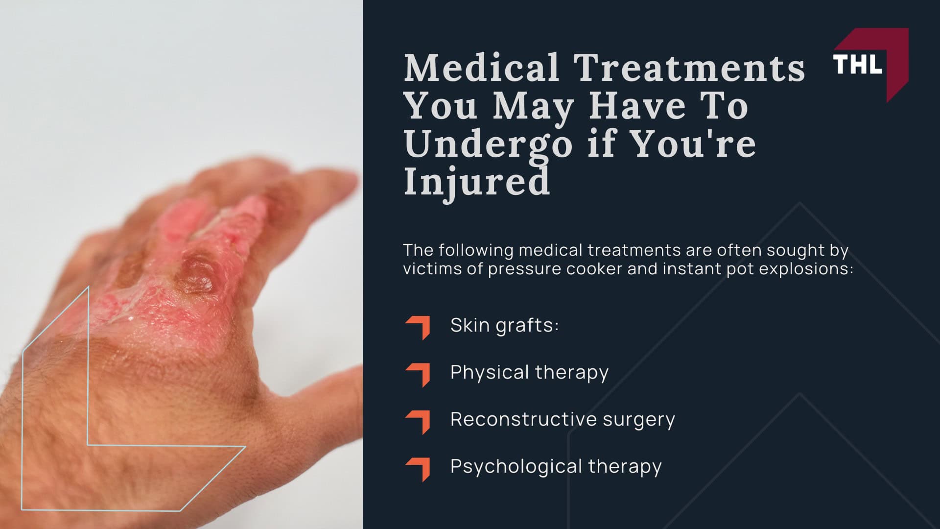 Pressure Cooker Burn Lawyer Are Pressure Cookers Dangerous - How Pressure Cookers Work - torhoerman law; Pressure Cooker Burn Lawyer Are Pressure Cookers Dangerous - How To Use a Pressure Cooker - torhoerman law; Pressure Cooker Burn Lawyer Are Pressure Cookers Dangerous - Electric Pressure Cooker Safety Features - torhoerman law; Pressure Cooker Burn Lawyer Are Pressure Cookers Dangerous - Causes of Pressure Cooker Explosions - torhoerman law; Pressure Cooker Burn Lawyer Are Pressure Cookers Dangerous - Potential Injuries From Defective Instant Pots - torhoerman law; Pressure Cooker Burn Lawyer Are Pressure Cookers Dangerous - Medical Treatments You May Have To Undergo if You're Injured - torhoerman law