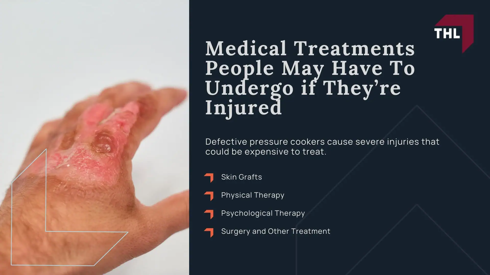 _Pressure Cooker Exploded The #1 Pressure Cooker Lawyers Can Help - Everything You Need To Know About Pressure Cooker Explosions; _Pressure Cooker Exploded The #1 Pressure Cooker Lawyers Can Help - Pressure Cooker Explosions in the News; _Pressure Cooker Exploded The #1 Pressure Cooker Lawyers Can Help - Why Do Pressure Cookers Explode; _Pressure Cooker Exploded The #1 Pressure Cooker Lawyers Can Help - Documented Recalls for Defective Pressure Cookers and Instant Pots; _Pressure Cooker Exploded The #1 Pressure Cooker Lawyers Can Help - Most Common Defective Pressure Cooker Injuries; _Pressure Cooker Exploded The #1 Pressure Cooker Lawyers Can Help - Medical Treatments People May Have To Undergo if They’re Injured