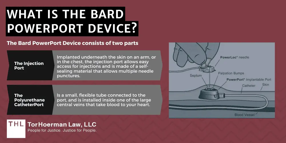 Bard PowerPort Lawsuit