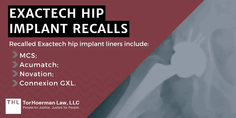 Exactech Hip Implant Recalls