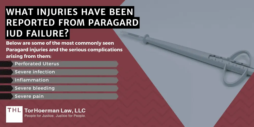 Paragard Lawsuit FAQ Is There a Lawsuit Against Paragard; Is There a Lawsuit Against Paragard; Paragard Lawsuit; Paragard Lawsuits; Paragard IUD Lawsuit; Paragard Lawyers; Paragard Lawyer; Paragard MDL; Is There A Lawsuit Against Paragard; Recent Paragard Lawsuit Updates; Why Is The Paragard Intrauterine Device (IUD) Dangerous?; What Injuries Have Been Reported From Paragard IUD Failure