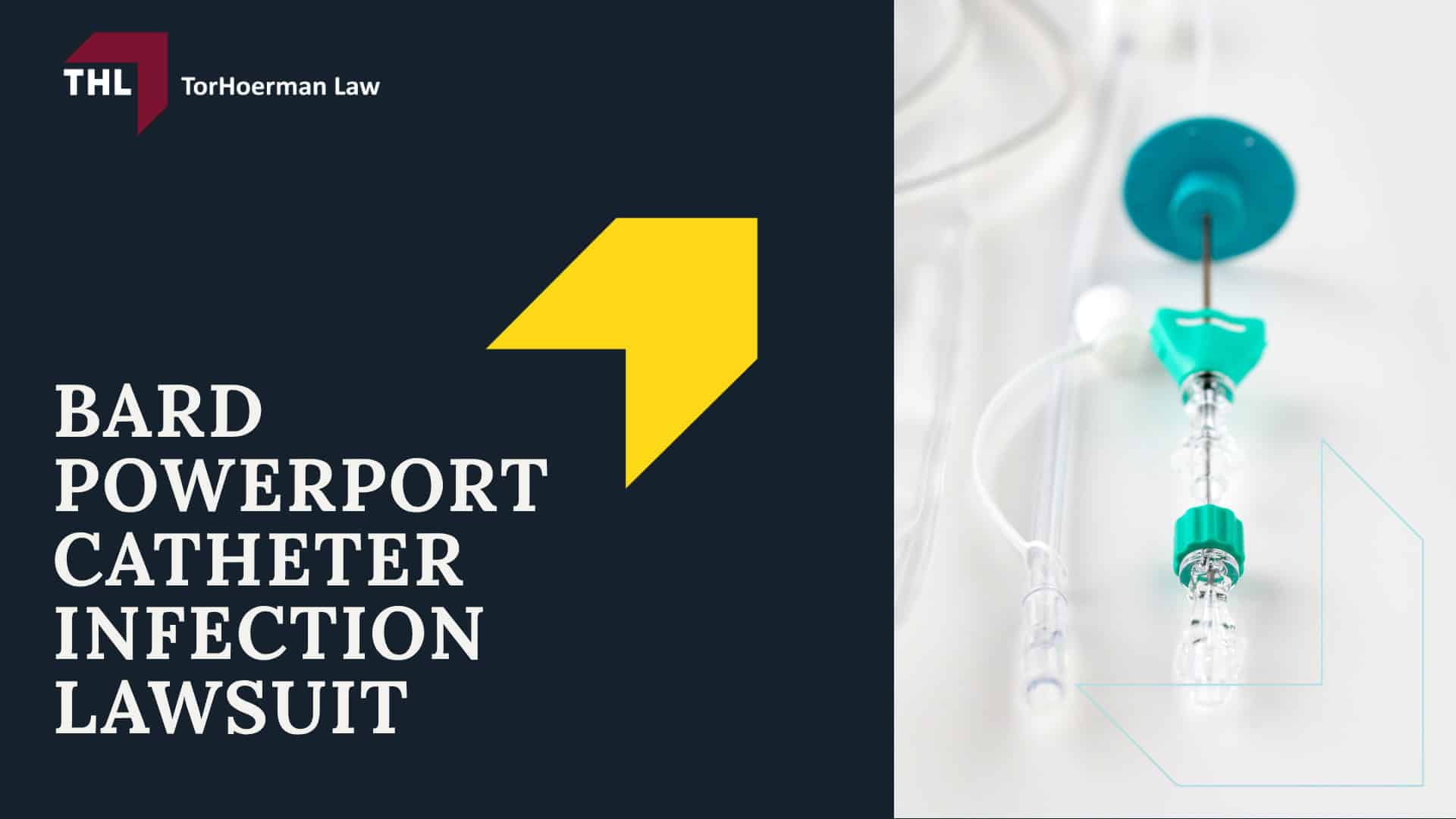Bard PowerPort Lawsuits for Complications and Injuries; Bard PowerPort Complications and Injuries; PowerPort Complications_ Symptoms To Watch For; What Is the Bard PowerPort Lawsuit; Elements of the Bard PowerPort Lawsuit; What is the Bard PowerPort Multidistrict Litigation (MDL); What is the Average Bard PowerPort Settlement Amount; What is the Average Bard PowerPort Settlement Amount