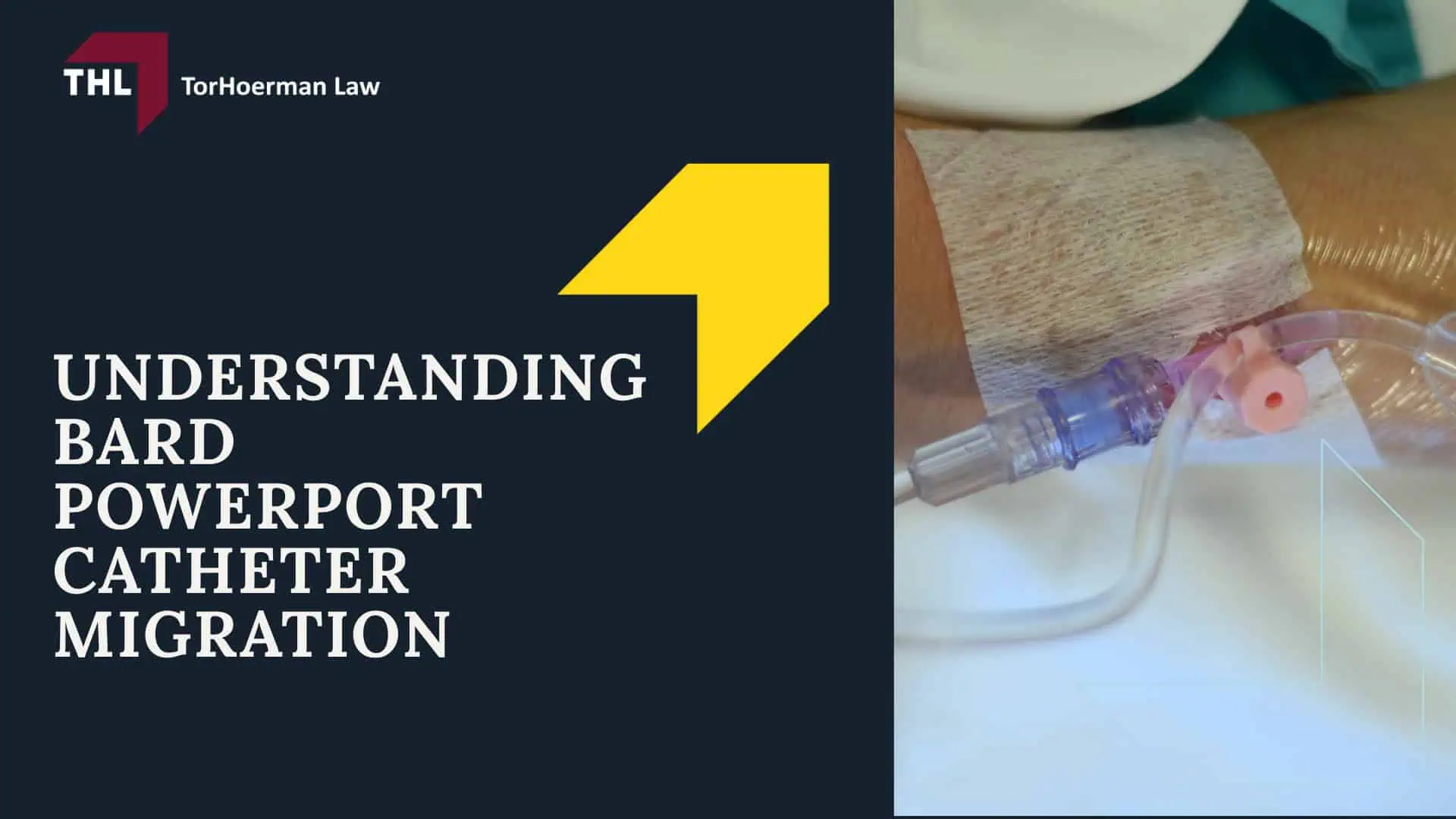Bard PowerPort Migration Lawsuit - Intro to the Bard PowerPort Migration Lawsuits - torhoerman law; Bard PowerPort Migration Lawsuit - What Is the Bard PowerPort Device_ - torhoerman law; Bard PowerPort Migration Lawsuit - Who Uses Bard PowerPort Devices_ - torhoerman law; Bard PowerPort Migration Lawsuit - Known Complications Associated With Bard PowerPort - torhoerman law Devices; Bard PowerPort Migration Lawsuit - Intro to the Bard PowerPort Migration Lawsuits - torhoerman law; Bard PowerPort Migration Lawsuit - What Is the Bard PowerPort Device_ - torhoerman law; Bard PowerPort Migration Lawsuit - Who Uses Bard PowerPort Devices_ - torhoerman law; Bard PowerPort Migration Lawsuit - Known Complications Associated With Bard PowerPort - torhoerman law Devices
