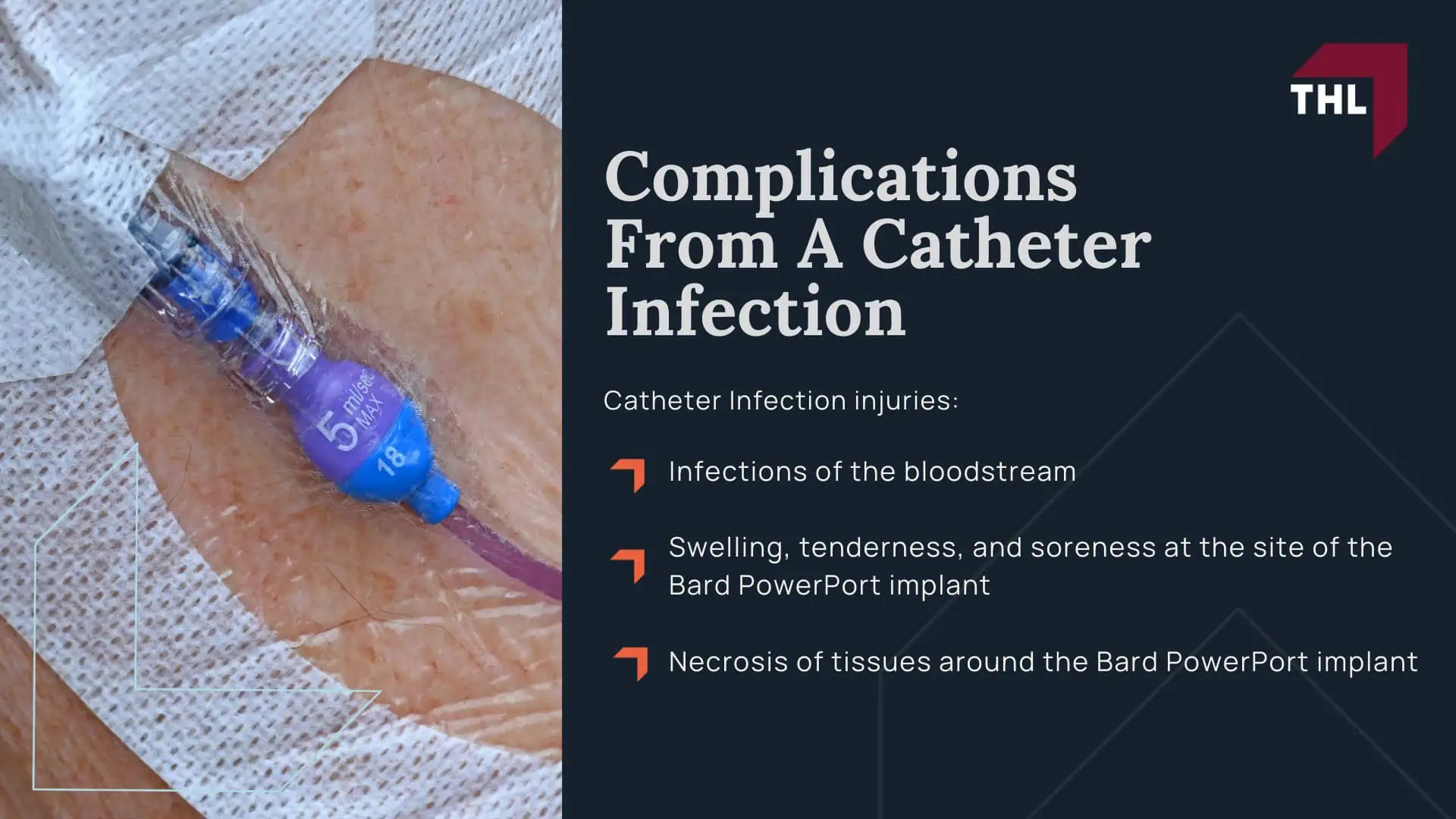 Breast Mesh Lawsuit - What Bard PowerPort Devices are Named in the Lawsuit_ - torhoerman law; Breast Mesh Lawsuit - Bard PowerPort Lawsuit Updates and Overview - torhoerman law; Breast Mesh Lawsuit - What Is the Bard PowerPort Device and Why Are Lawsuits Being Filed_ - torhoerman law; Breast Mesh Lawsuit - Reports of Device Defects and Patient Harm - torhoerman law; Breast Mesh Lawsuit - How Many Bard PowerPort Lawsuits Have Been Filed_ Current Status of the Bard PowerPort MDL - torhoerman law; Breast Mesh Lawsuit - Bard PowerPort Settlement Amounts_ Projections & Estimates - torhoerman law; Breast Mesh Lawsuit - Serious Health Risks Linked to the Bard Power Port Device - torhoerman law; Breast Mesh Lawsuit - Complications From A Catheter Fracture - torhoerman law; Breast Mesh Lawsuit - Complications From A Catheter Infection - torhoerman law