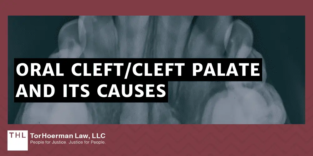 Oral Cleft_Cleft Palate And Its Causes