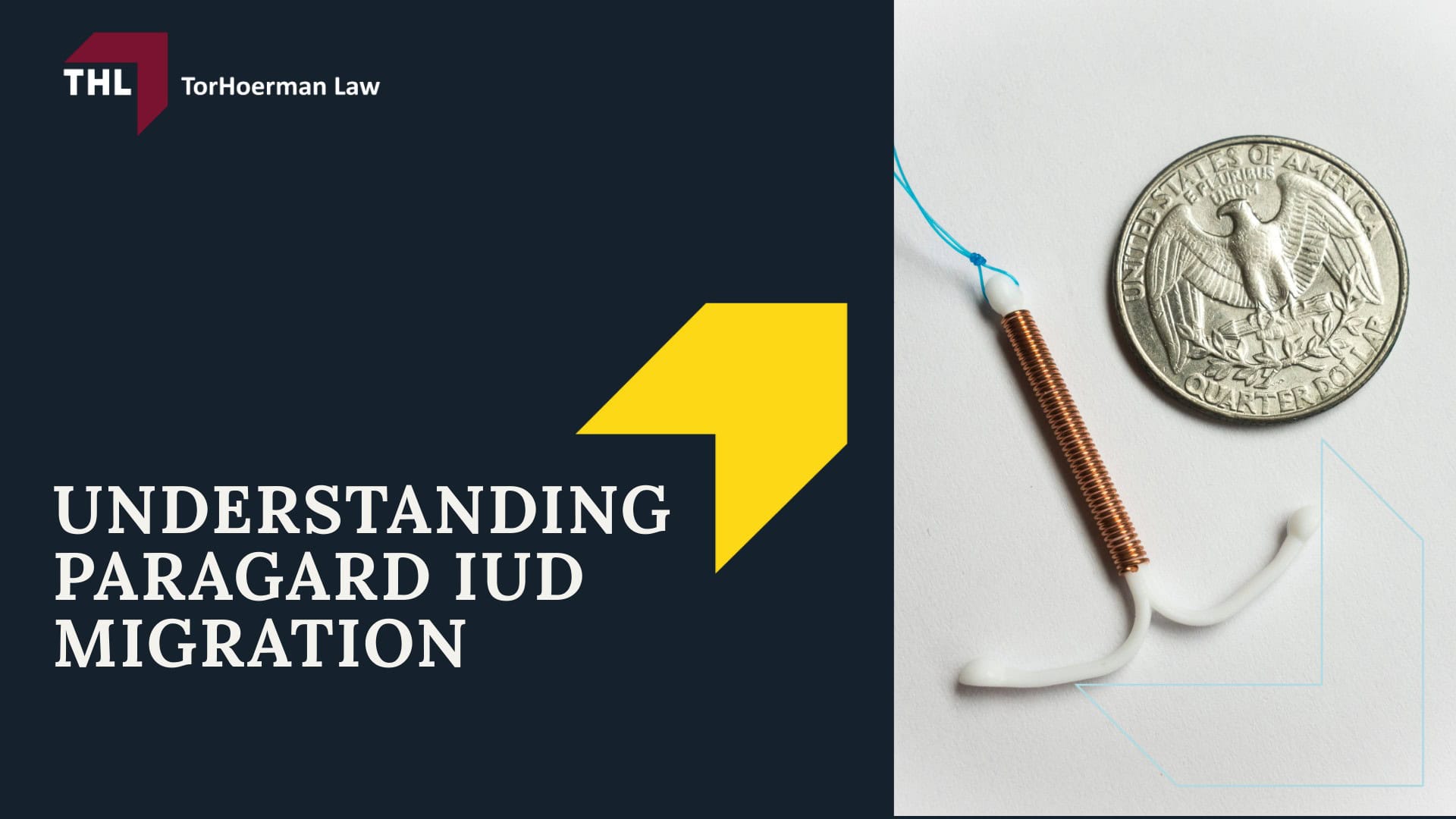 Paragard Migration Injury Lawsuit - About The Paragard Intrauterine Device (IUD) - torhoerman law; Paragard Migration Injury Lawsuit - Understanding Paragard IUD Migration - torhoerman law