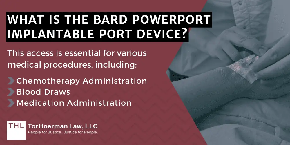 What Is The Bard PowerPort Implantable Port Device
