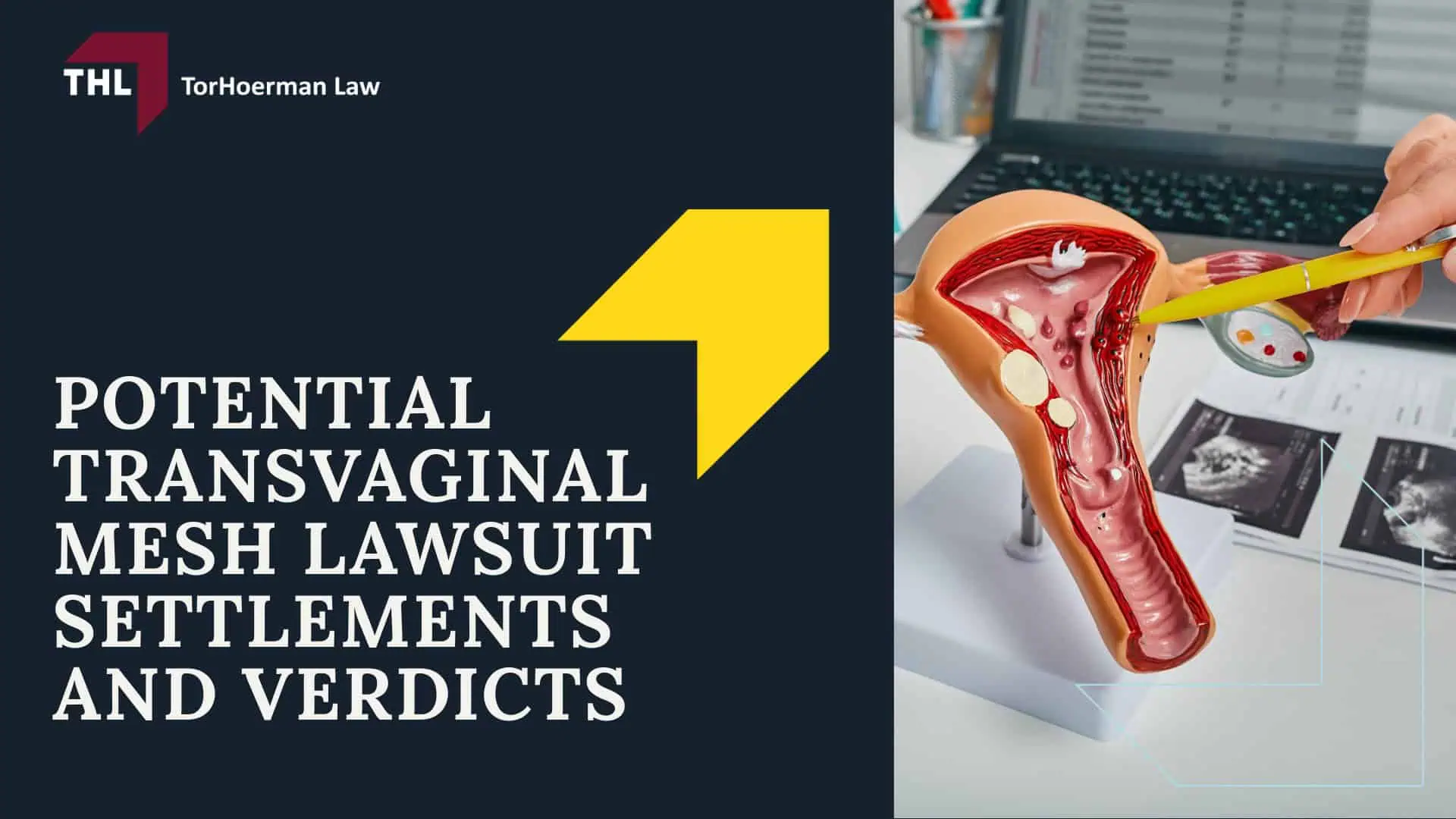 Potential Transvaginal Mesh Lawsuit Settlements and Verdicts; Potential Transvaginal Mesh Lawsuit Settlements and Verdicts; #1 Vaginal Mesh Lawyers for Transvaginal Mesh Injuries - Potential Transvaginal Mesh Lawsuit Settlements and Verdicts