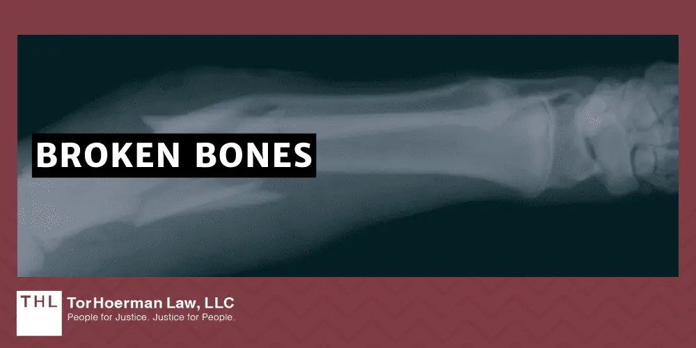 What Are the Most Common Construction Injuries; Most Common Construction Injuries; Construction Accidents; Construction Accident; Construction Injury; Construction Injury Lawyer; Construction Accident Lawsuit; Most Common Accidents On Construction Sites_ An Overview; Falls From Heights; Injuries From Machinery And Equipment; Electrocutions And Electrical Shocks; Being Struck By Falling Objects; Overexertion Injuries; Repetitive Stress Injuries; Caught-In_Between Injuries; Traumatic Brain Injuries; Broken Bones