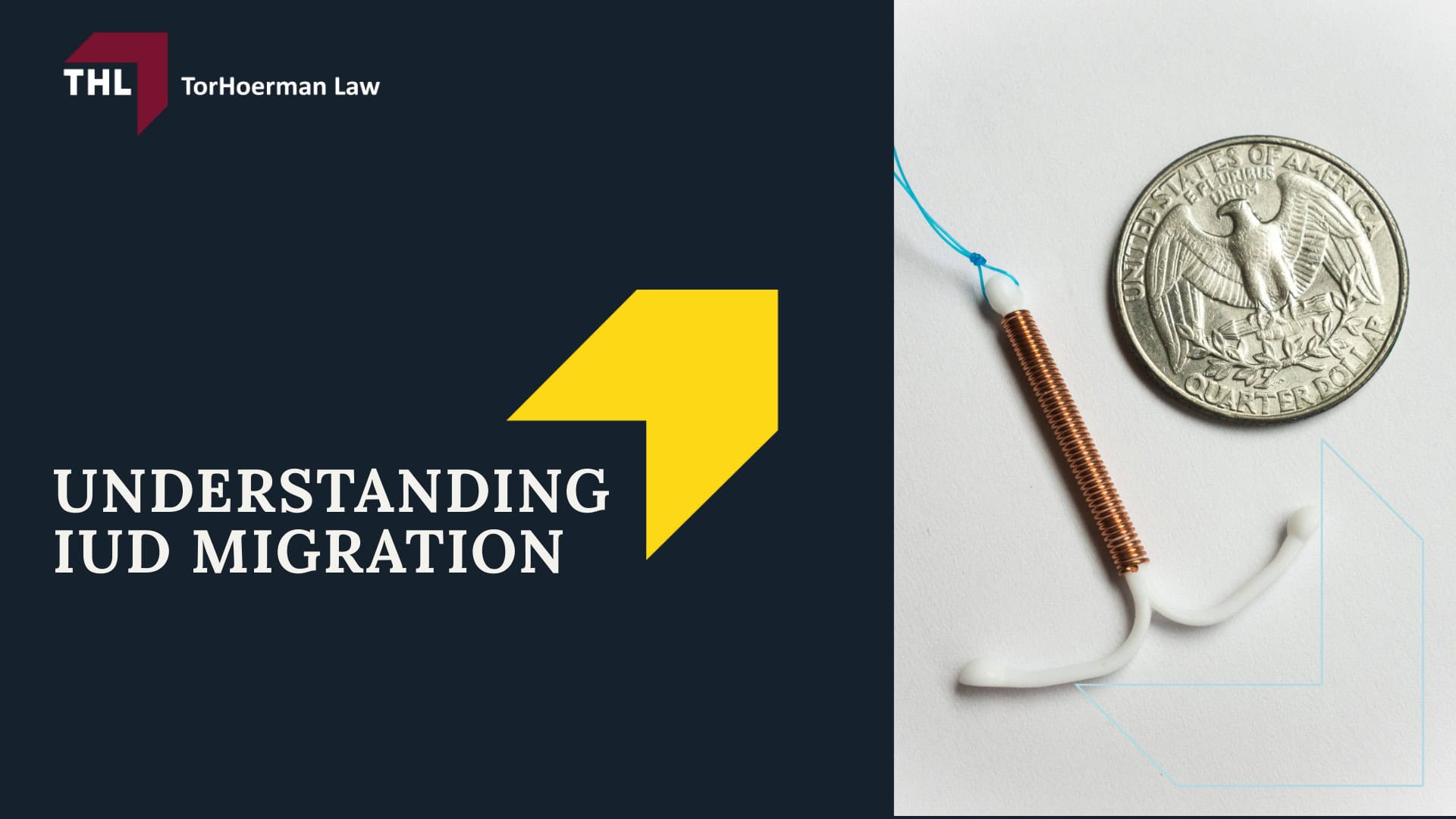 FAQ What Is the Surgical Treatment for IUD Migration - What Is the Paragard IUD - torhoerman law; FAQ What Is the Surgical Treatment for IUD Migration - Understanding IUD Migration - torhoerman law