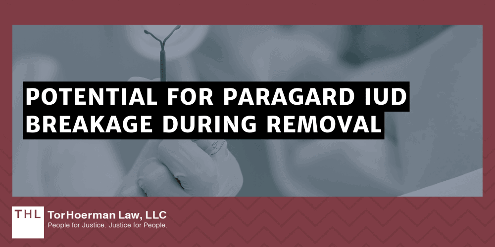 Can I File a Lawsuit if My IUD Broke During Removal; IUD Broke During Removal; Paragard Lawsuit; Paragard IUD Lawsuits; Paragard IUD Lawsuit; Overview Of The Paragard IUD And Potential Complications; Potential For Paragard IUD Breakage During Removal