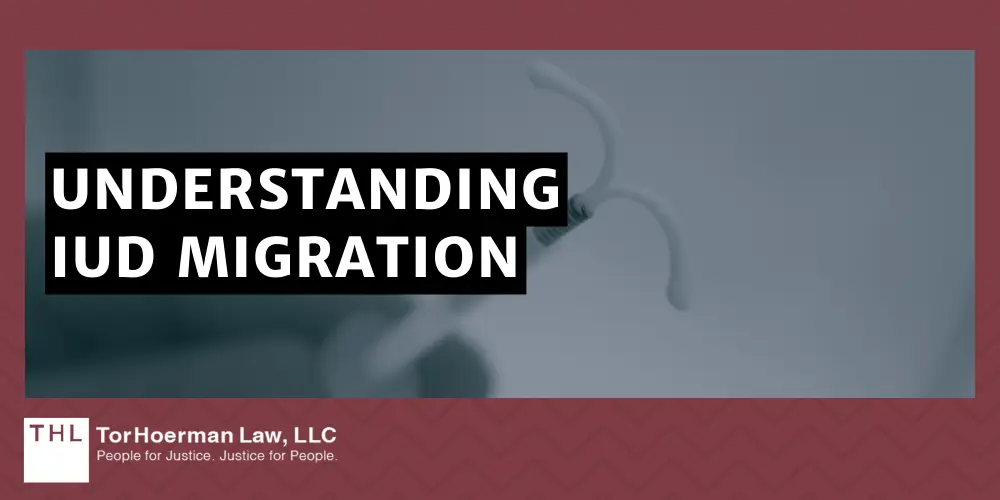 Surgical Treatment for IUD Migration; Paragard Lawsuit; Paragard IUD Lawsuit; Paragard Lawsuits; Paragard Lawyers; Paragard Migration; Paragard Fracture; Paragard MDL; What Is The Paragard IUD; Understanding IUD Migration