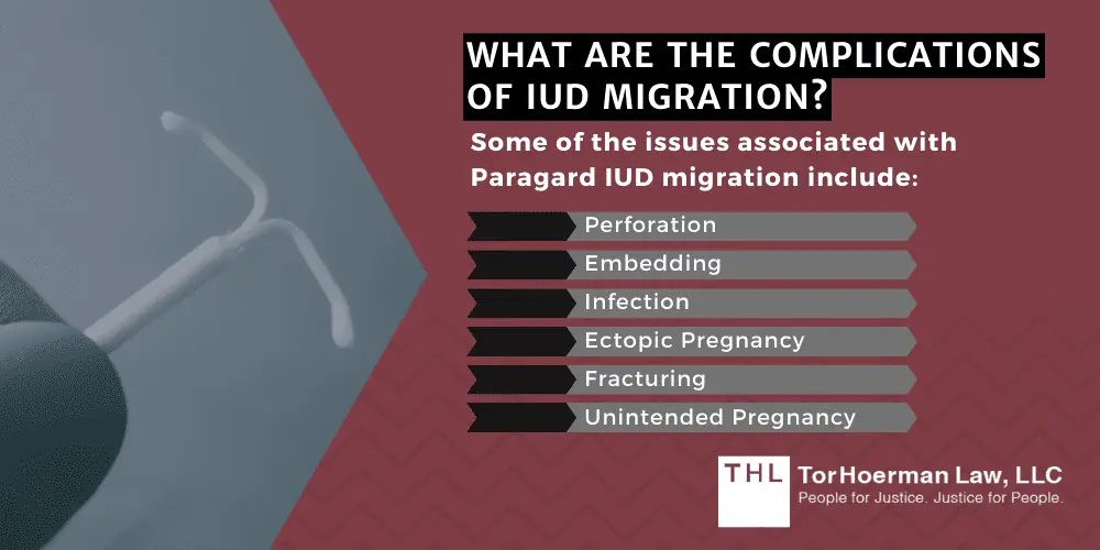 Surgical Treatment for IUD Migration; Paragard Lawsuit; Paragard IUD Lawsuit; Paragard Lawsuits; Paragard Lawyers; Paragard Migration; Paragard Fracture; Paragard MDL; What Is The Paragard IUD; Understanding IUD Migration; What Does IUD Migration Mean; What Are The Complications Of IUD Migration