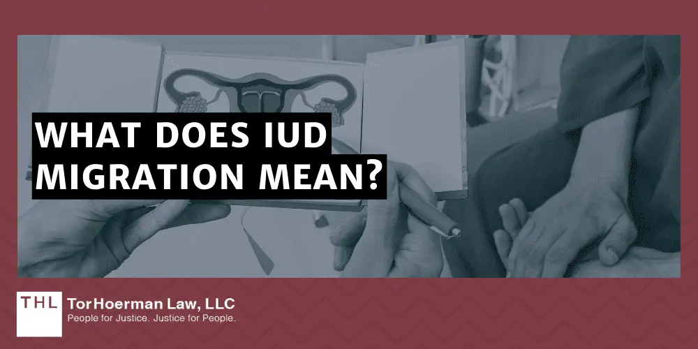 Surgical Treatment for IUD Migration; Paragard Lawsuit; Paragard IUD Lawsuit; Paragard Lawsuits; Paragard Lawyers; Paragard Migration; Paragard Fracture; Paragard MDL; What Is The Paragard IUD; Understanding IUD Migration; What Does IUD Migration Mean