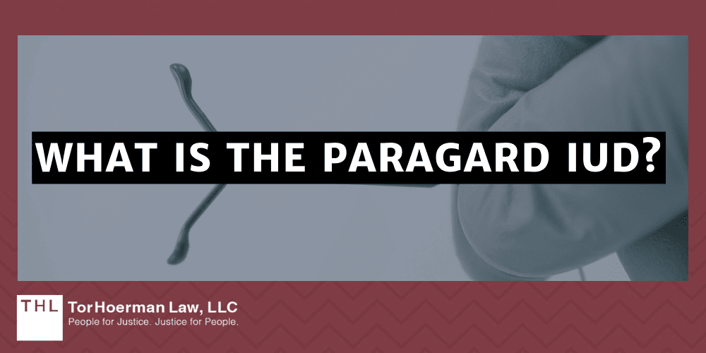 Surgical Treatment for IUD Migration; Paragard Lawsuit; Paragard IUD Lawsuit; Paragard Lawsuits; Paragard Lawyers; Paragard Migration; Paragard Fracture; Paragard MDL; What Is The Paragard IUD