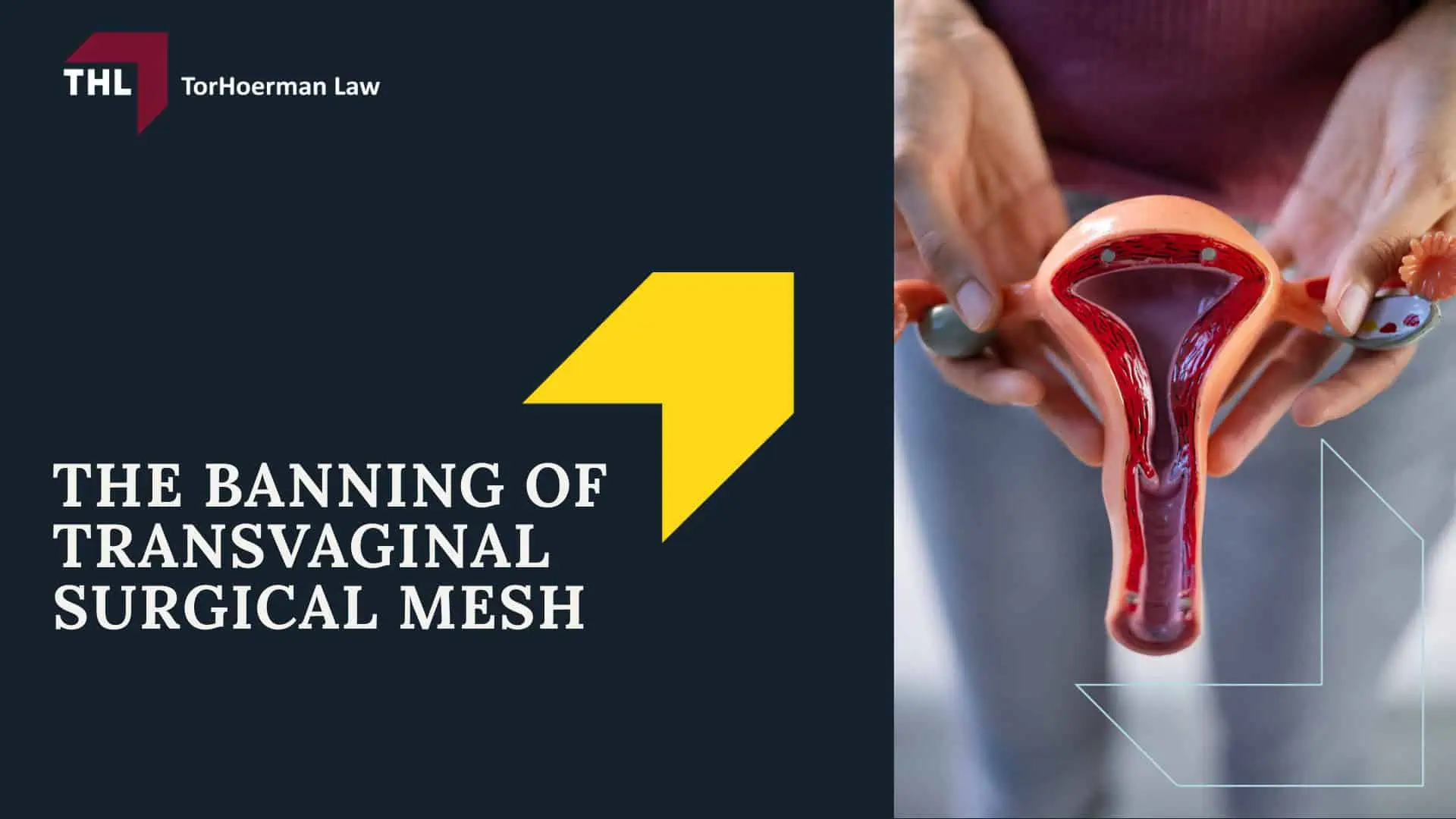 American Medical Systems Transvaginal Mesh Lawsuit - Vaginal Mesh Lawsuits Against AMS - torhoerman law; American Medical Systems Transvaginal Mesh Lawsuit - What Is a Transvaginal Mesh Implant_ - torhoerman law; American Medical Systems Transvaginal Mesh Lawsuit - The History of Pelvic Mesh Lawsuits Against American Medical Systems - torhoerman law; American Medical Systems Transvaginal Mesh Lawsuit - The Banning of Transvaginal Surgical Mesh - torhoerman law