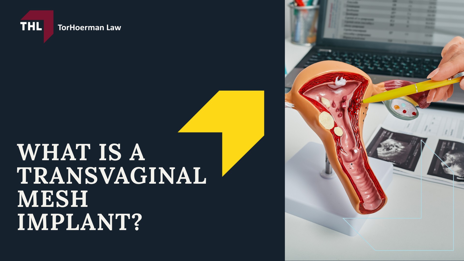 American Medical Systems Transvaginal Mesh Lawsuit - Vaginal Mesh Lawsuits Against AMS - torhoerman law; American Medical Systems Transvaginal Mesh Lawsuit - What Is a Transvaginal Mesh Implant_ - torhoerman law