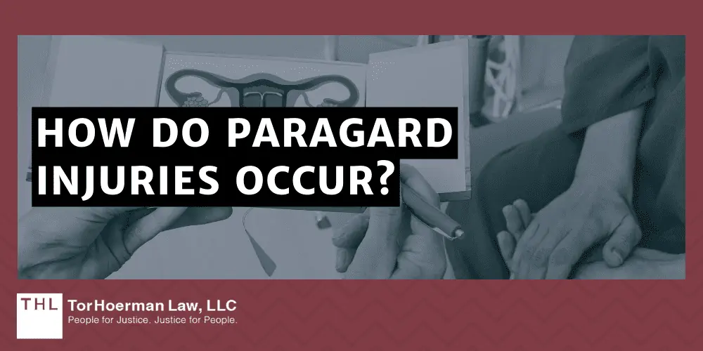 How Do Paragard Injuries Occur
