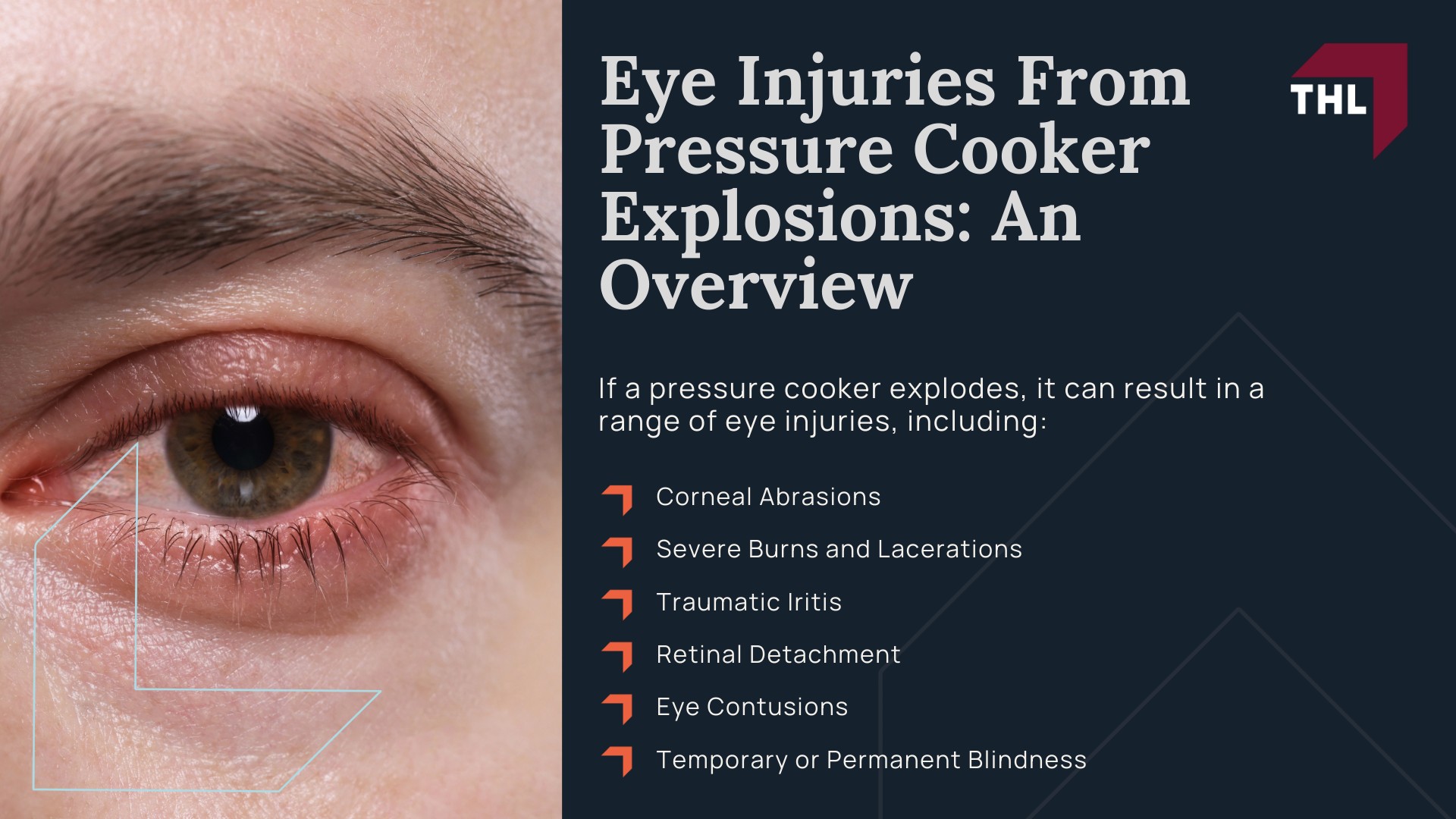 Pressure Cooker Eye Injury Lawsuit - Eye Injuries From Pressure Cooker Explosions_ An Overview - torhoerman law