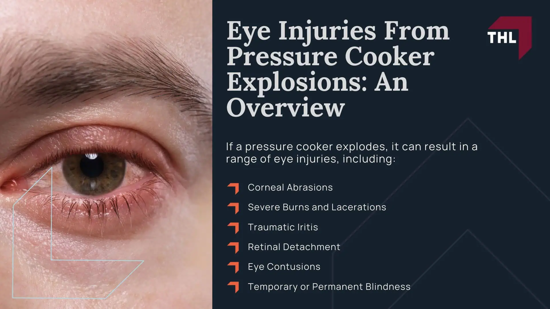 Pressure Cooker Eye Injury Lawsuit - Eye Injuries From Pressure Cooker Explosions_ An Overview - torhoerman law