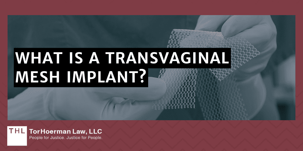 American Medical Systems Transvaginal Mesh Lawsuit; Vaginal Mesh Lawsuit; Transvaginal Mesh Lawsuit; Transvaginal Mesh Lawsuits; Vaginal Mesh Lawsuits; Vaginal Mesh Lawsuits Against AMS; What Is A Transvaginal Mesh Implant