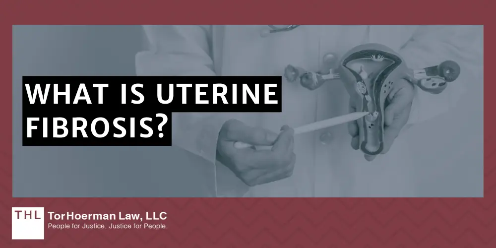 What Is Uterine Fibrosis