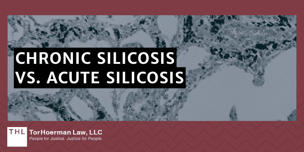 Chronic Silicosis Vs. Acute Silicosis