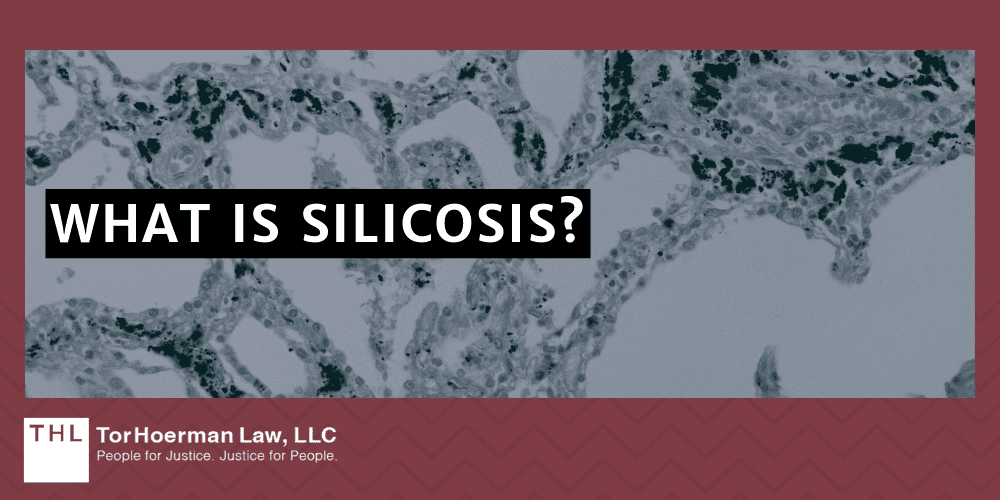 What Is Silicosis