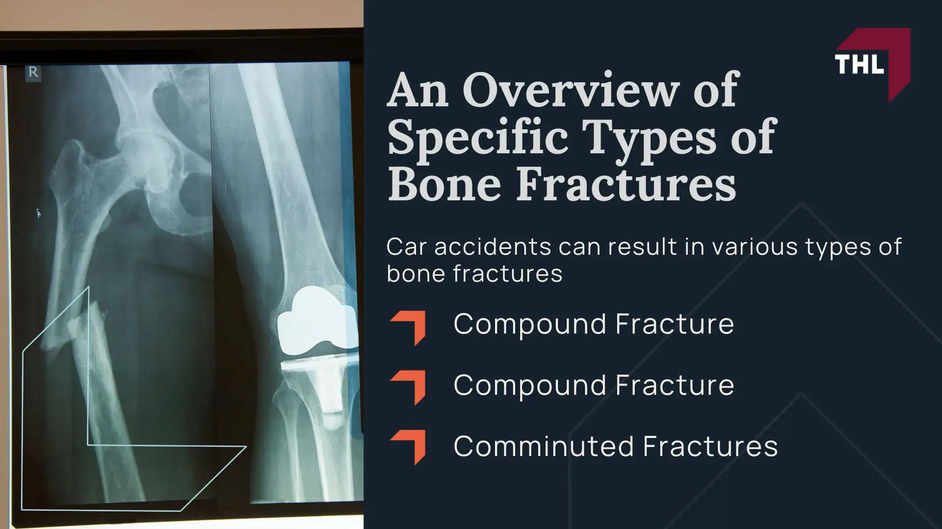 An Overview of Specific Types of Bone Fractures