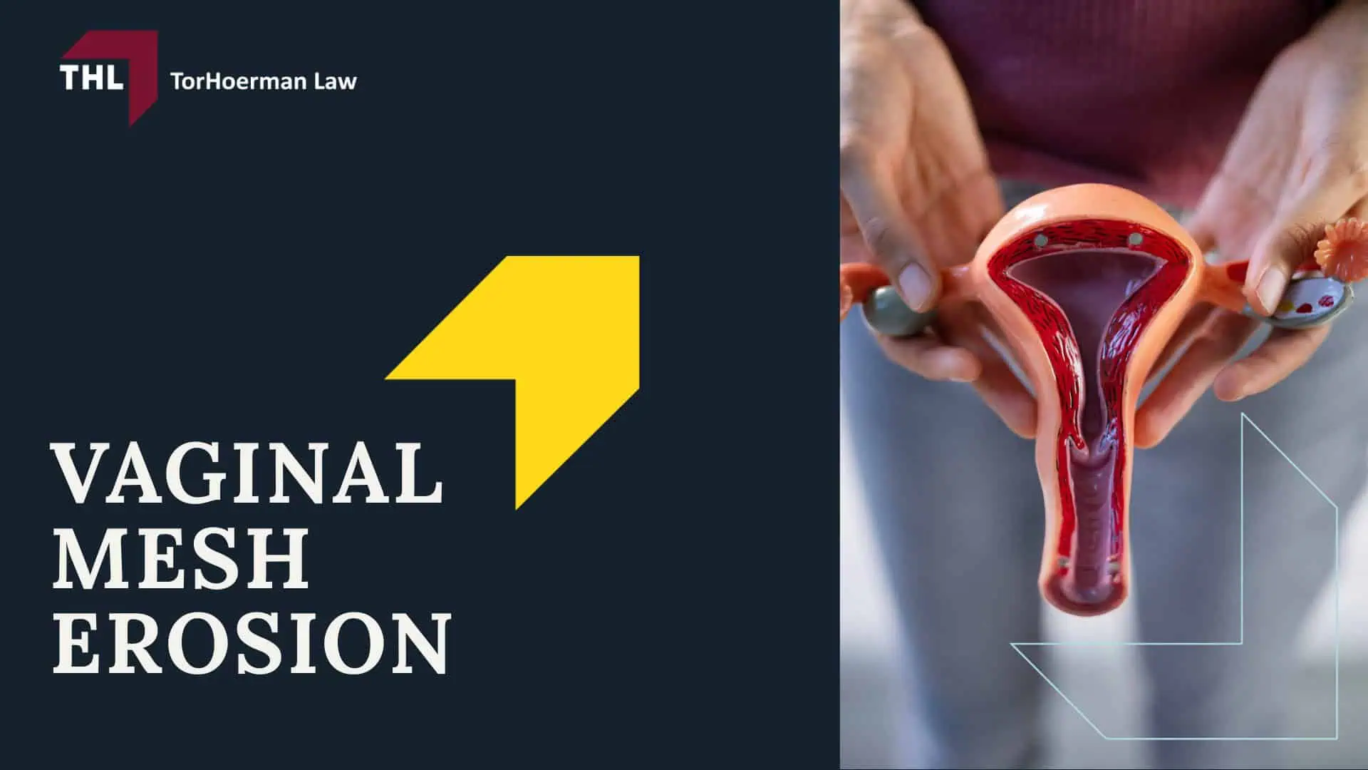 Vaginal Mesh Erosion Lawsuit - Vaginal Mesh and Its Uses - torhoerman law; Vaginal Mesh Erosion Lawsuit - Vaginal Mesh Erosion - torhoerman law