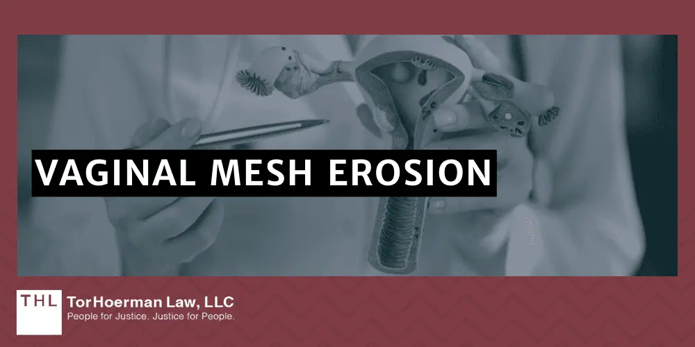Vaginal Mesh Erosion