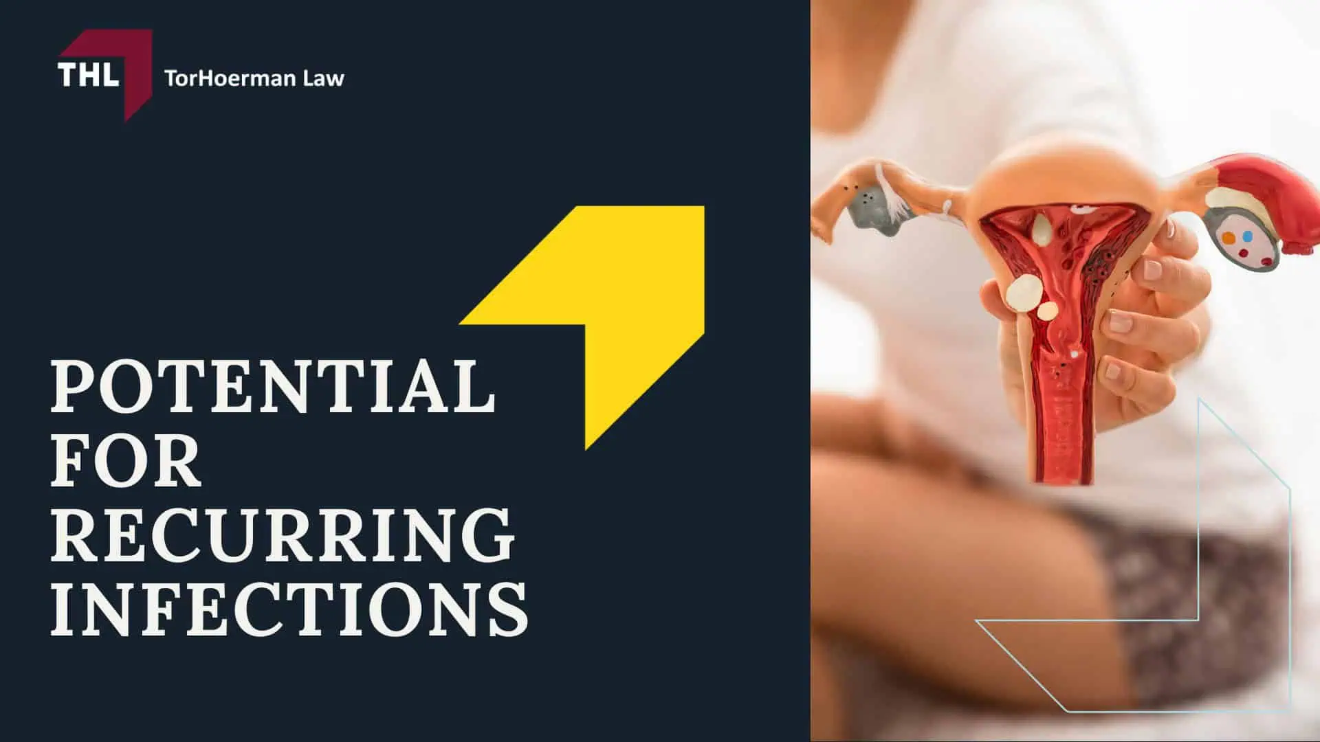 Vaginal Mesh Infection Lawsuit - What Is Vaginal Mesh - torhoerman law; Vaginal Mesh Infection Lawsuit - Pelvic Organ Prolapse (POP) - torhoerman law; Vaginal Mesh Infection Lawsuit - Stress Urinary Incontinence (SUI) - torhoerman law; Vaginal Mesh Infection Lawsuit - Understanding Vaginal Mesh Infection - torhoerman law; Vaginal Mesh Infection Lawsuit - Causes of Vaginal Mesh Complications That Lead to Infection - torhoerman law; Vaginal Mesh Infection Lawsuit - Symptoms of Vaginal Mesh Infection - torhoerman law; Vaginal Mesh Infection Lawsuit - The Potential Severity of Vaginal Mesh Infections - torhoerman law; Vaginal Mesh Infection Lawsuit - The Health Implications of Vaginal Mesh Infections - torhoerman law; Vaginal Mesh Infection Lawsuit - Necessary Medical Treatments - torhoerman law; Vaginal Mesh Infection Lawsuit - Potential for Recurring Infections - torhoerman law