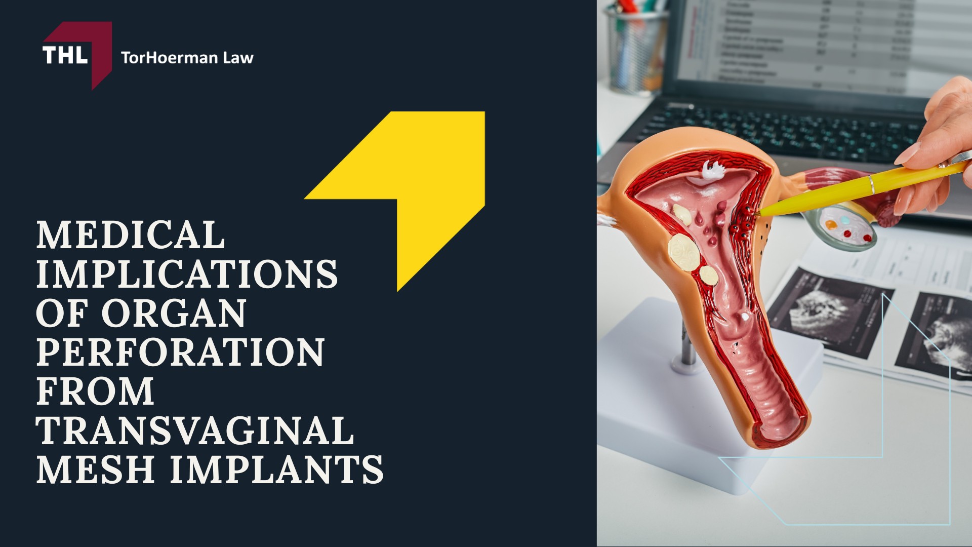 Vaginal Mesh Organ Perforation Lawsuit - On the Use of Vaginal Mesh - torhoerman law; Vaginal Mesh Organ Perforation Lawsuit - What is the Purpose of Transvaginal Mesh - torhoerman law; Vaginal Mesh Organ Perforation Lawsuit - The Applications of Transvaginal Mesh - torhoerman law; Vaginal Mesh Organ Perforation Lawsuit - 2019 Ban by the Food and Drug Administration - torhoerman law; Vaginal Mesh Organ Perforation Lawsuit - Vaginal Mesh Organ Perforation - torhoerman law; Vaginal Mesh Organ Perforation Lawsuit - How Vaginal Mesh Organ Perforation Occurs - torhoerman law; Vaginal Mesh Organ Perforation Lawsuit - Symptoms of Organ Perforation - torhoerman law; Vaginal Mesh Organ Perforation Lawsuit - Medical Implications of Organ Perforation From Transvaginal Mesh Implants - torhoerman law