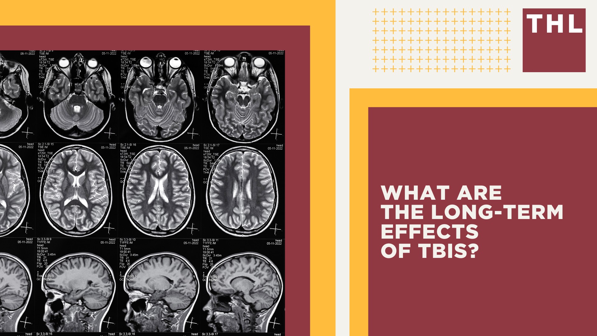 An Overview of TBIs; The Common Causes of TBIs on Construction Sites; What Are the Long-Term Effects of TBIs
