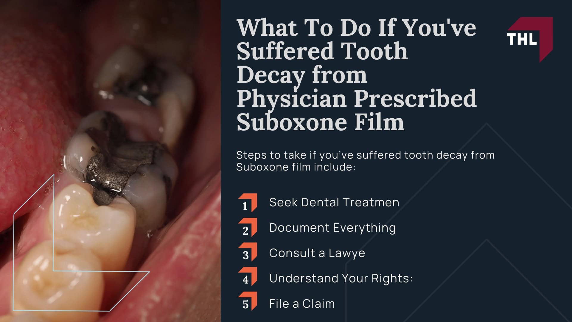 Suboxone Lawsuit Payout Per Person - What is the Average Payout in the Suboxone Tooth Decay Lawsuit - torhoerman law; Suboxone Lawsuit Payout Per Person - How is Compensation in the Suboxone Tooth Decay Lawsuit Determined - torhoerman law; Suboxone Lawsuit Payout Per Person - Suboxone Film Linked to Severe Dental Complications and Tooth Decay - torhoerman law; Suboxone Lawsuit Payout Per Person - Dental Work Often Needed by Suboxone Users - torhoerman law; Suboxone Lawsuit Payout Per Person - A Brief Overview of the Suboxone Tooth Decay Lawsuits - torhoerman law; Suboxone Lawsuit Payout Per Person - Is There a Suboxone Class Action Lawsuit - torhoerman law; Suboxone Lawsuit Payout Per Person - What is the Statute of Limitations for Suboxone Tooth Decay Lawsuits - torhoerman law; Suboxone Lawsuit Payout Per Person - Who Qualifies to File a Suboxone Lawsuit - torhoerman law; Suboxone Lawsuit Payout Per Person - What To Do If You've Suffered Tooth Decay from Physician Prescribed Suboxone Film - torhoerman law