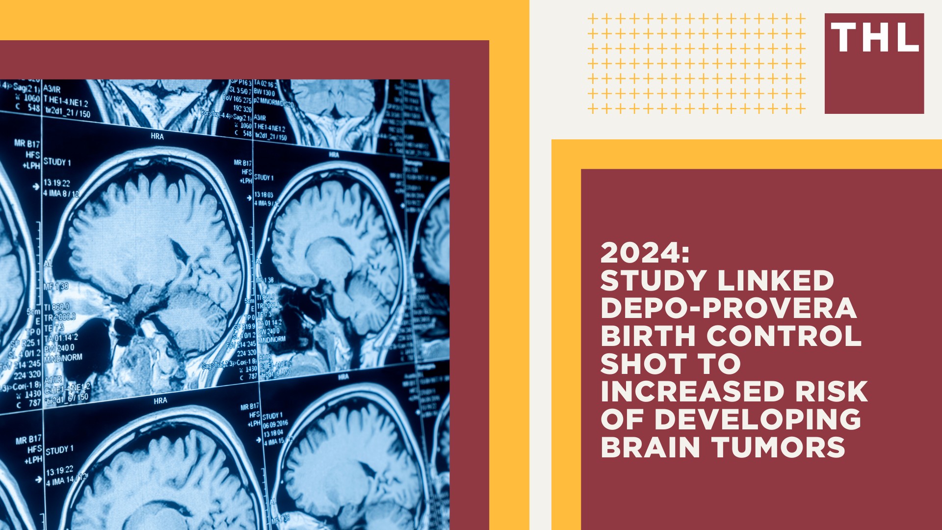 2024_ Study Linked Depo-Provera Birth Control Shot to Increased Risk of Developing Brain Tumors