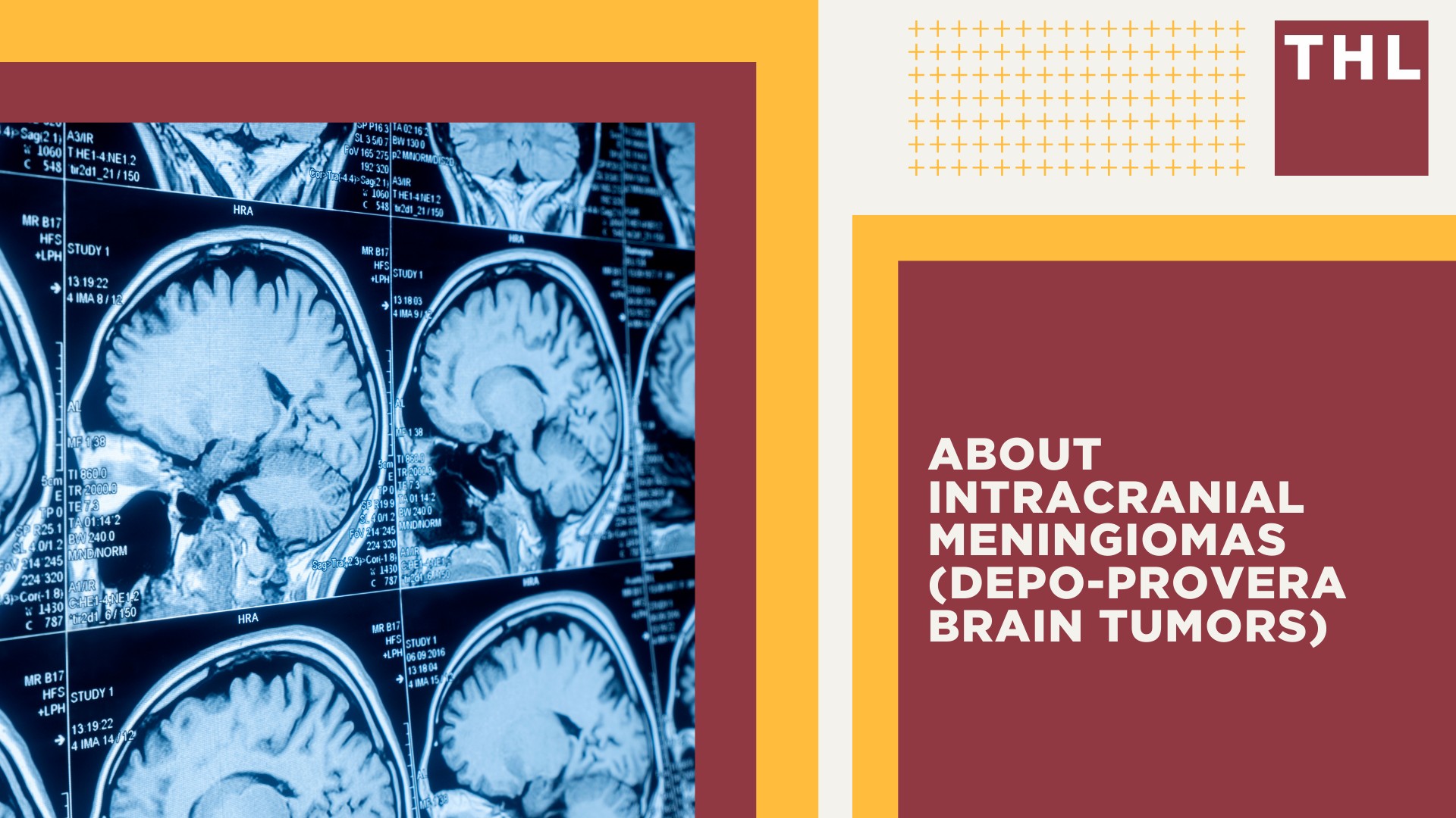 Depo-Provera Users Who Developed Brain Tumors are Filing Lawsuits; Who Exactly May Qualify for the Depo-Provera Lawsuit;  Use of Depo-Provera Injections Linked to Brain Tumors; About Intracranial Meningiomas (Depo-Provera Brain Tumors)