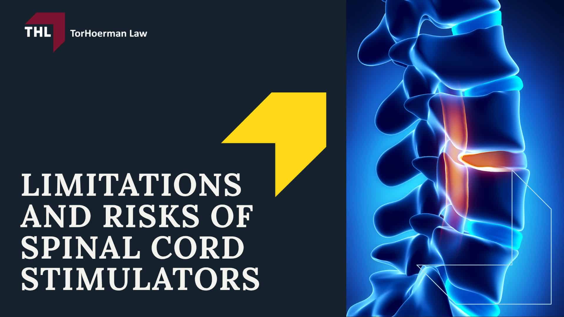 Spinal Cord Stimulator Lawsuit Overview; What Do Spinal Cord Stimulator Lawsuits Allege; What is the Average Spinal Stimulator Lawsuit Settlement Amount; Spinal Cord Stimulator Injury Risks; What is Spinal Cord Stimulation; How are Spinal Cord Stimulators Implanted;  Types of Spinal Cord Stimulator Devices and Manufacturers; Limitations and Risks of Spinal Cord Stimulators