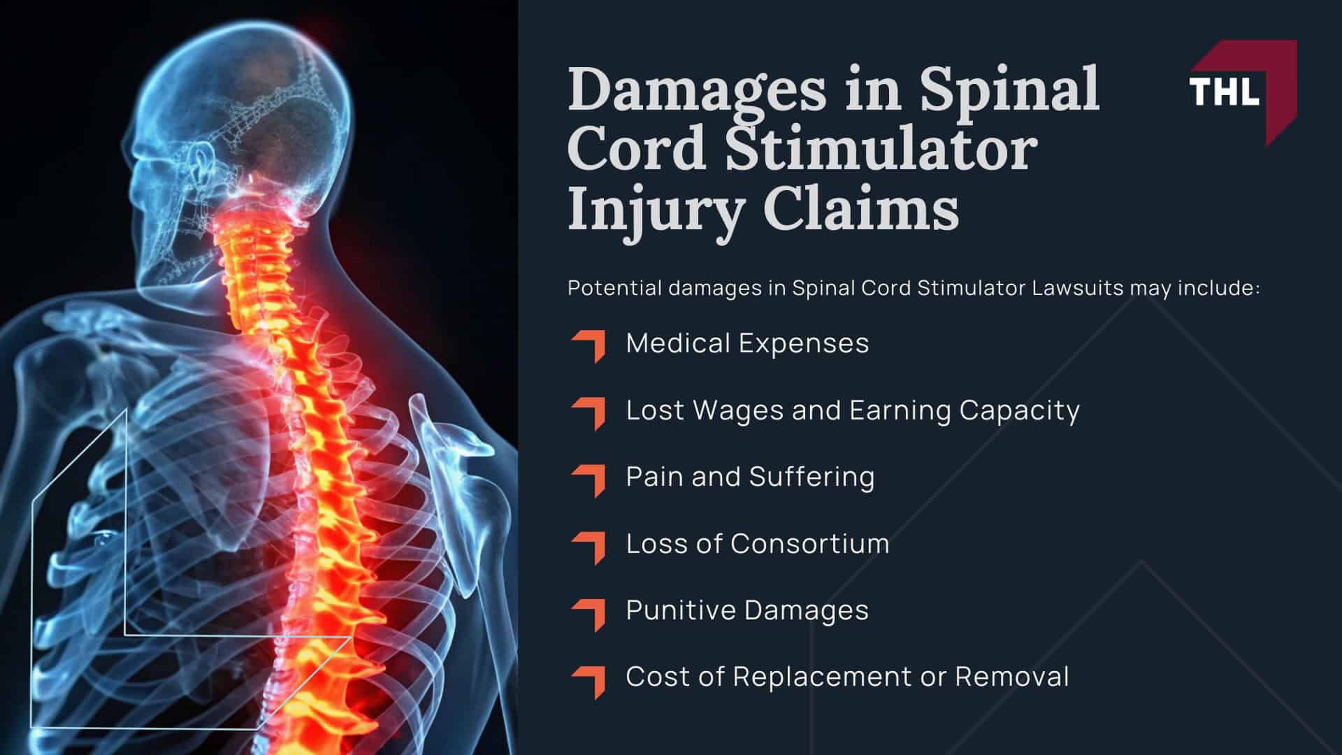 Spinal Cord Stimulator Lawsuit - Spinal Cord Stimulator Lawsuit Overview - torhoerman law; Spinal Cord Stimulator Lawsuit - Spinal Cord Stimulator Injury Risks - torhoerman law; Spinal Cord Stimulator Lawsuit - What is Spinal Cord Stimulation - torhoerman law; Spinal Cord Stimulator Lawsuit - Purpose of Spinal Cord Stimulators Explained - torhoerman law; Spinal Cord Stimulator Lawsuit - How are Spinal Cord Stimulators Implanted_ - torhoerman law; Spinal Cord Stimulator Lawsuit - Types of Spinal Cord Stimulator Devices and Manufacturers - torhoerman law; Spinal Cord Stimulator Lawsuit - Limitations and Risks of Spinal Cord Stimulators - torhoerman law; Spinal Cord Stimulator Lawsuit - Spinal Cord Stimulator Lawsuit - Do You Qualify for a Spinal Cord Stimulator Lawsuit_ - torhoerman law; Spinal Cord Stimulator Lawsuit - Gathering Evidence for Spinal Cord Stimulator Lawsuits - torhoerman law; Spinal Cord Stimulator Lawsuit - Damages in Spinal Cord Stimulator Injury Claims - torhoerman law
