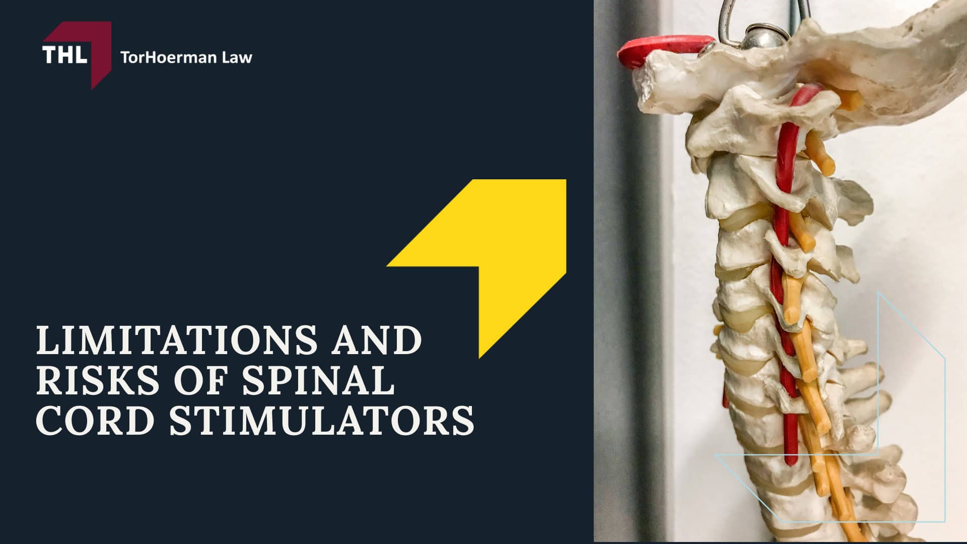 Spinal Cord Stimulator Lawsuit - Spinal Cord Stimulator Lawsuit Overview - torhoerman law; Spinal Cord Stimulator Lawsuit - Spinal Cord Stimulator Injury Risks - torhoerman law; Spinal Cord Stimulator Lawsuit - What is Spinal Cord Stimulation - torhoerman law; Spinal Cord Stimulator Lawsuit - Purpose of Spinal Cord Stimulators Explained - torhoerman law; Spinal Cord Stimulator Lawsuit - How are Spinal Cord Stimulators Implanted_ - torhoerman law; Spinal Cord Stimulator Lawsuit - Types of Spinal Cord Stimulator Devices and Manufacturers - torhoerman law; Spinal Cord Stimulator Lawsuit - Limitations and Risks of Spinal Cord Stimulators - torhoerman law