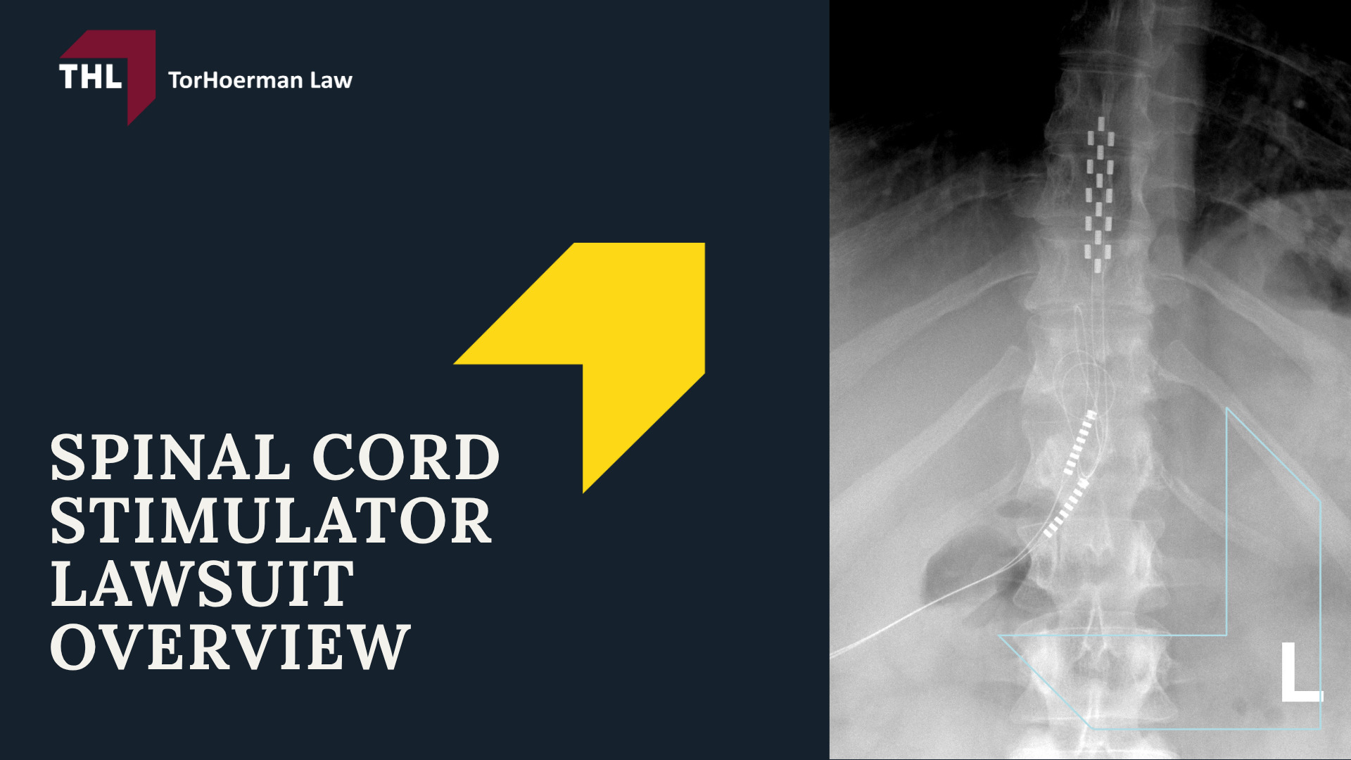 Spinal Cord Stimulator Lawsuit Overview