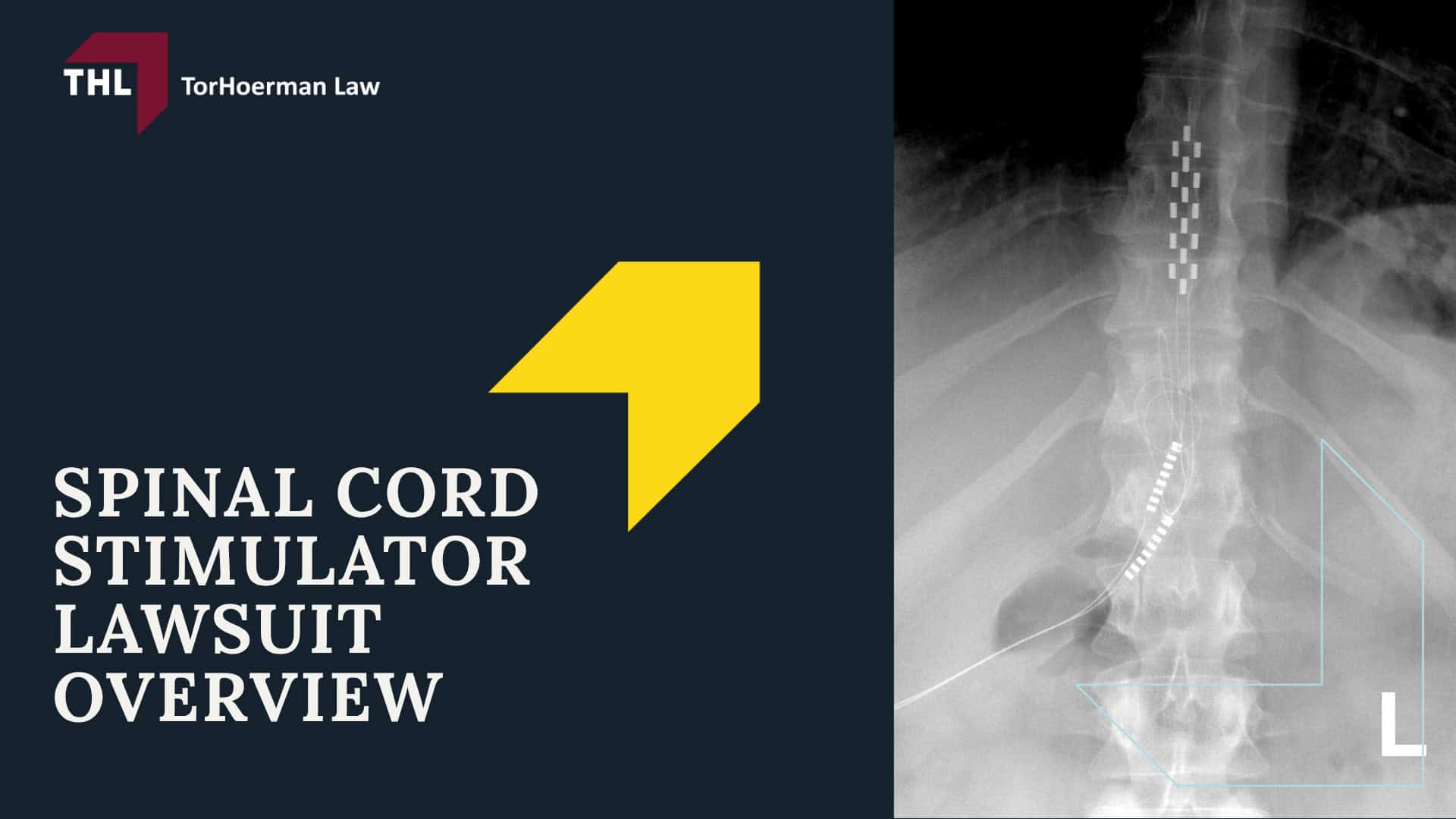 Spinal Cord Stimulator Lawsuit Overview